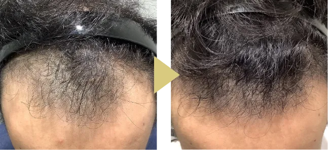 29歳男性、AGA治療1年11ヶ月のM字症例