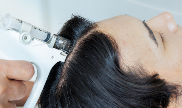 最新LHDV頭皮注入治療