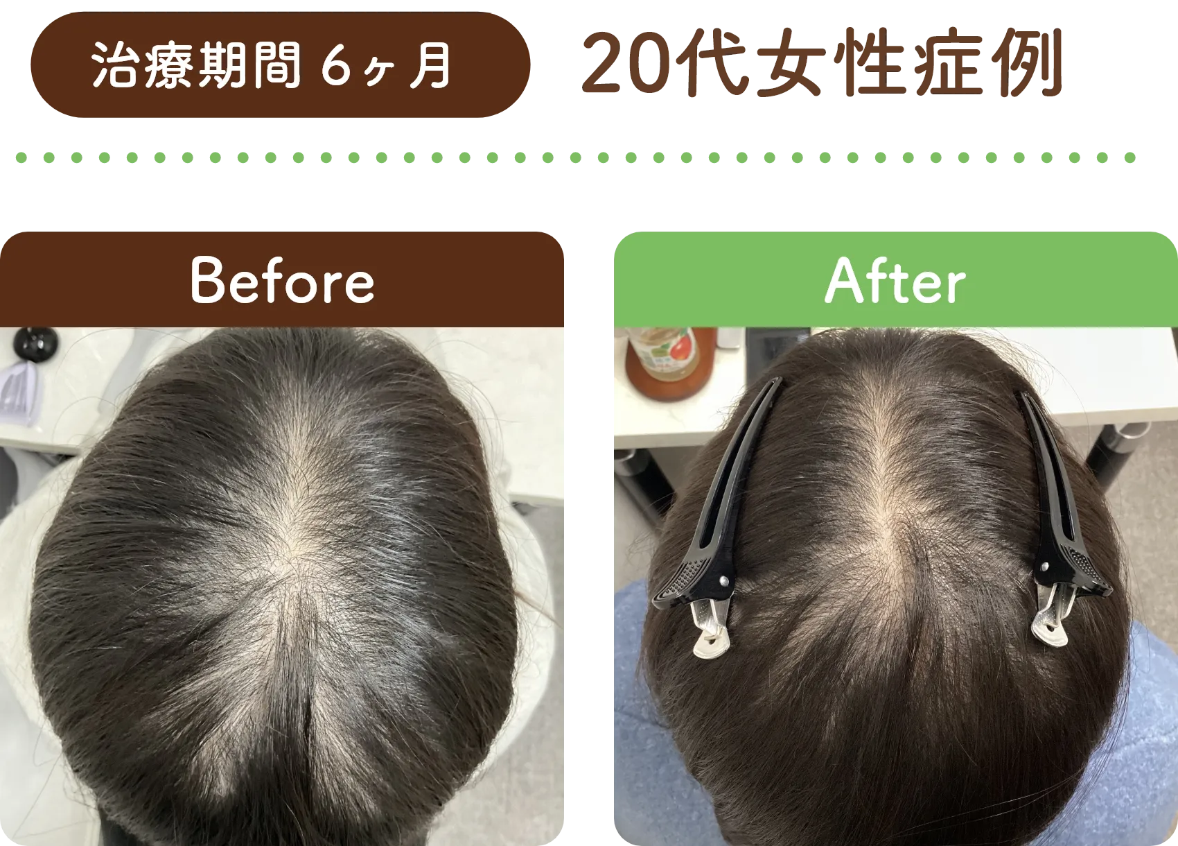 治療期間 6ヶ月 20代女性の症例写真