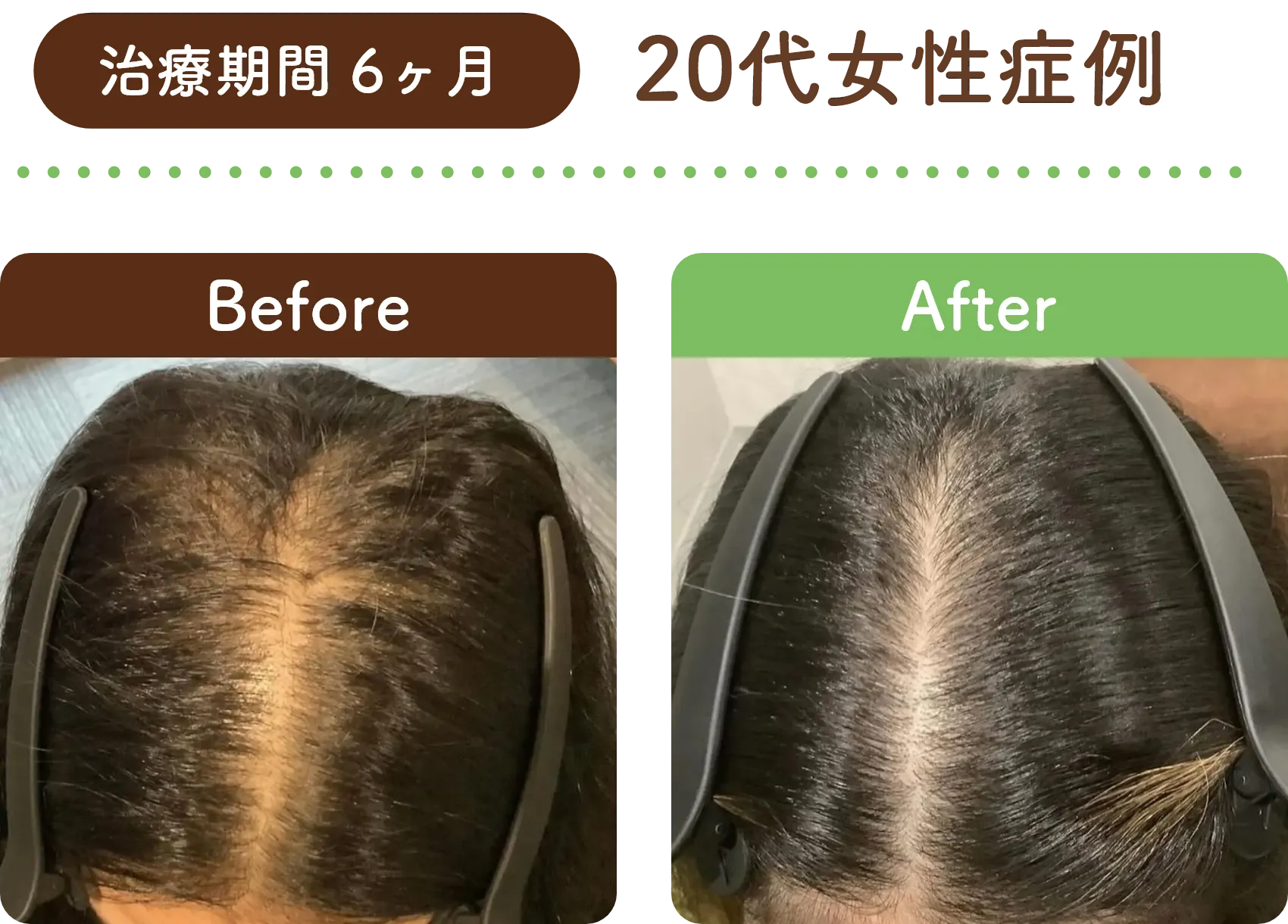 治療期間 6ヶ月 20代女性の症例写真