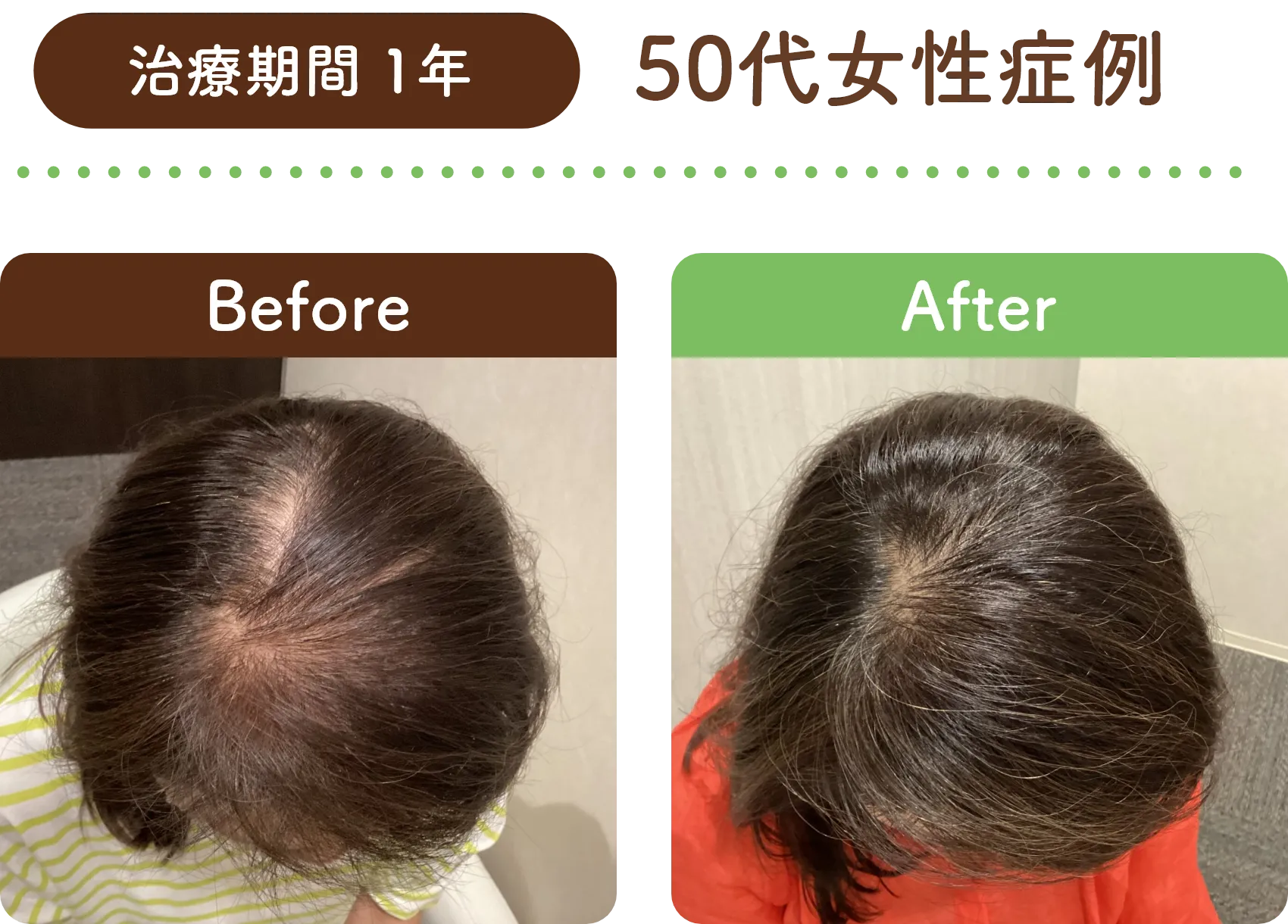 治療期間 1年 50代女性の症例写真