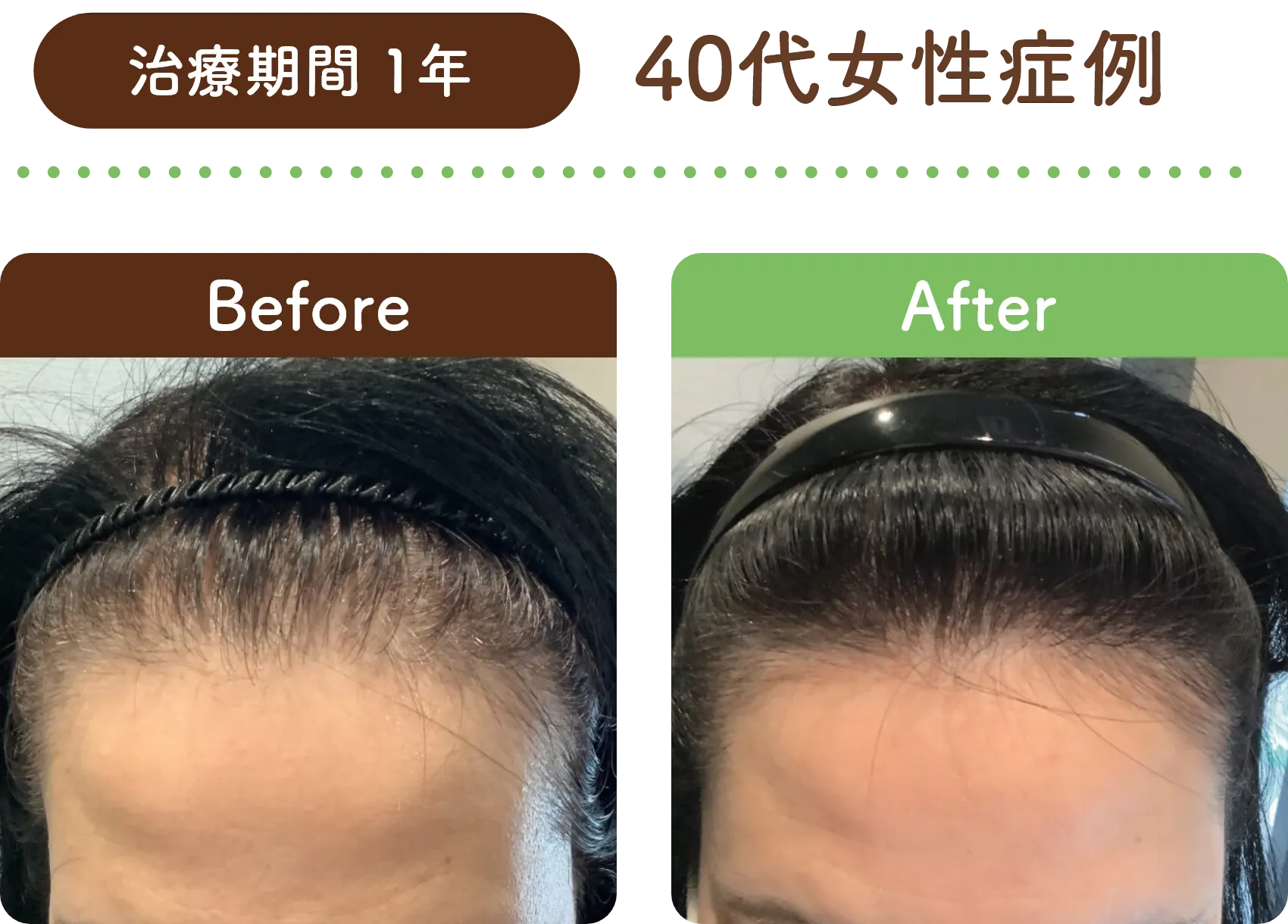 治療期間 1年 40代女性の症例写真