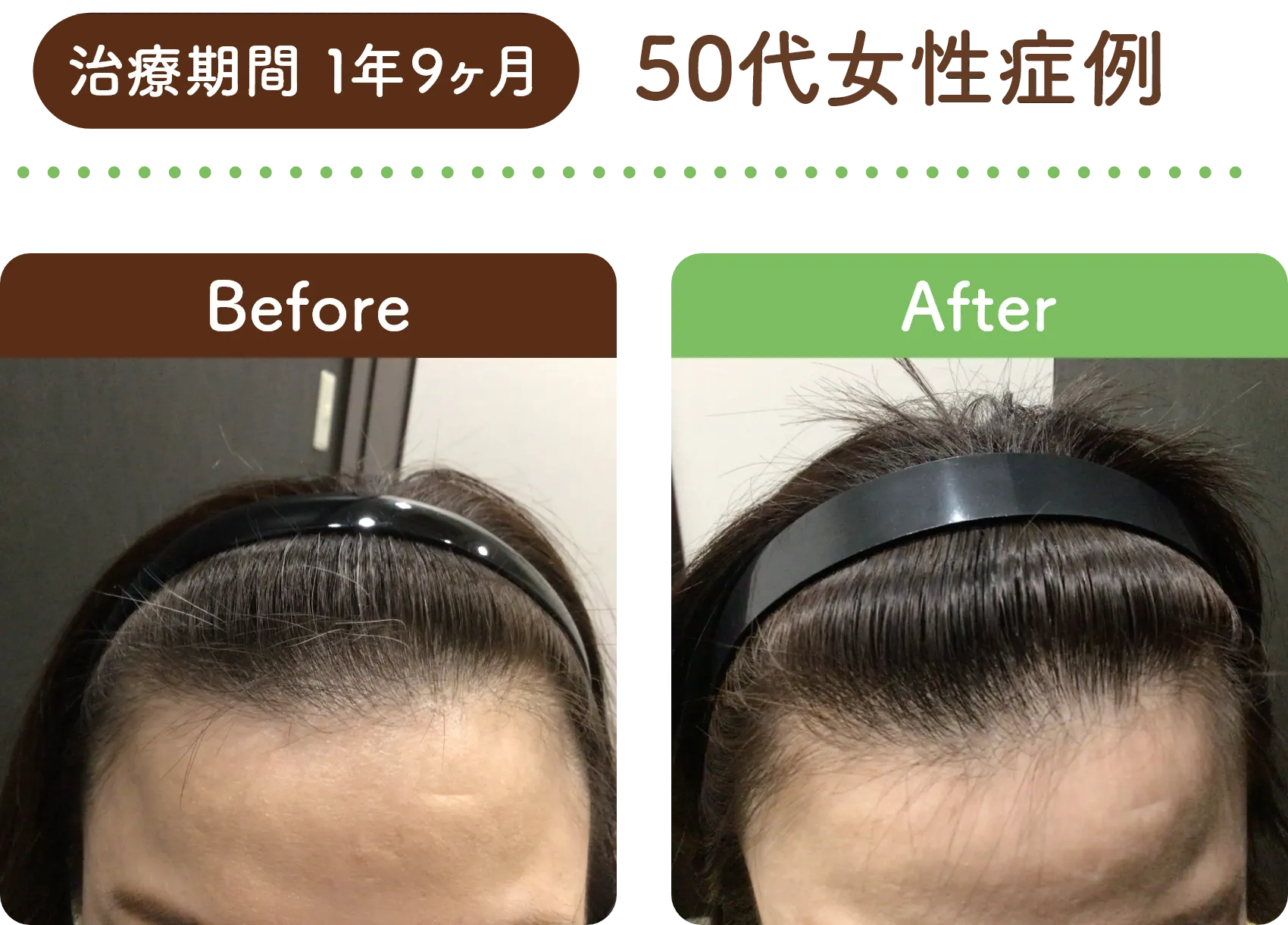治療期間 1年9ヶ月 50代女性の症例写真