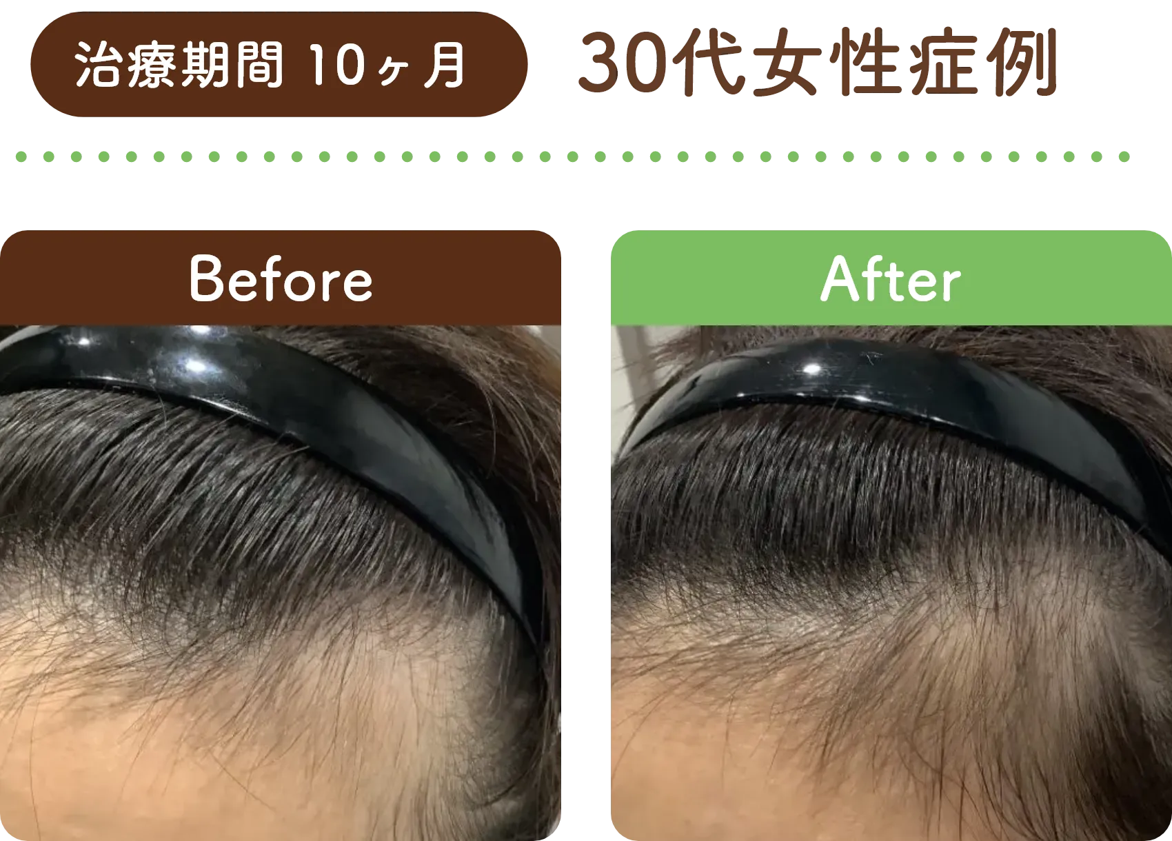 治療期間 10ヶ月 30代女性の症例写真