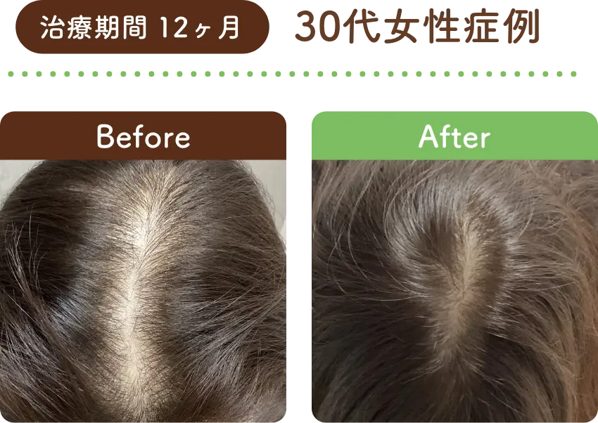 治療期間 1年 30代女性の症例写真