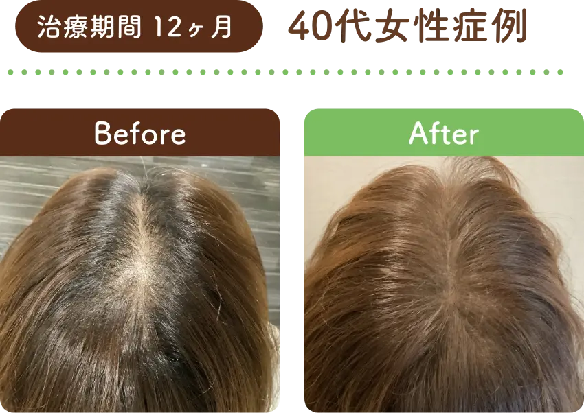 治療期間 1年 40代女性の症例写真