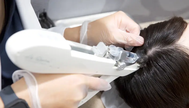 最新LHDV頭皮注入治療