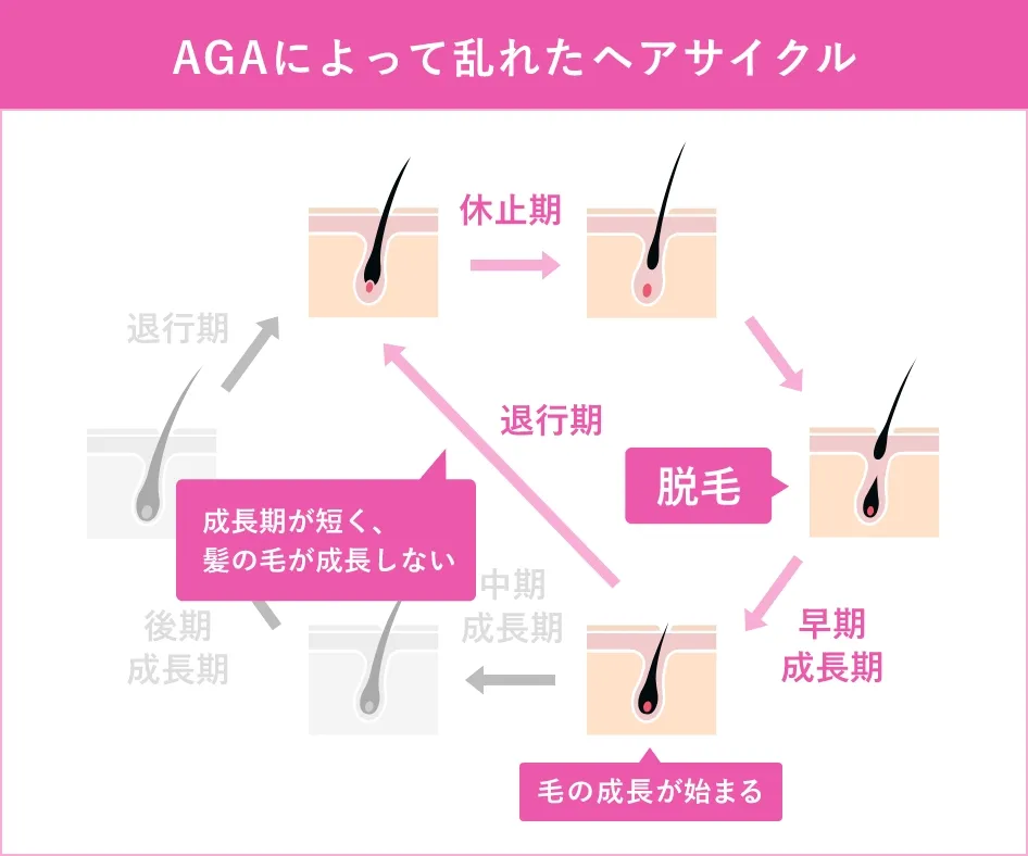 AGAによって乱れたヘアサイクル