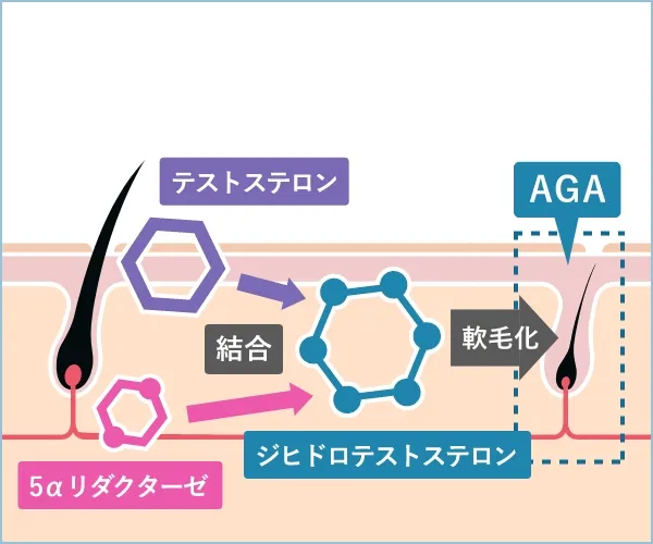 DHT（ジヒドロテストステロン）の増加によってAGAになる図解