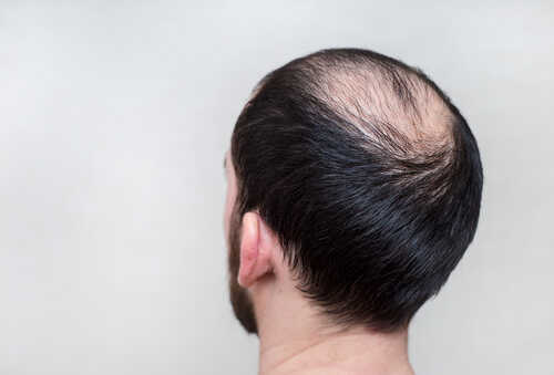 Agaの初期症状とは 治療時の初期脱毛の症状や期間も解説 Aga 抜け毛 女性薄毛治療の病院 ウィルagaクリニック