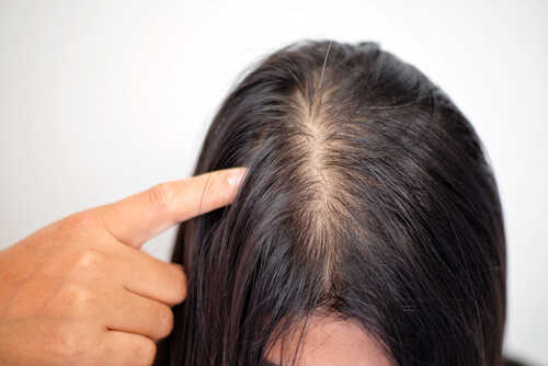 女性のつむじの薄毛とは 原因と対策を解説 公式 ウィルagaクリニック