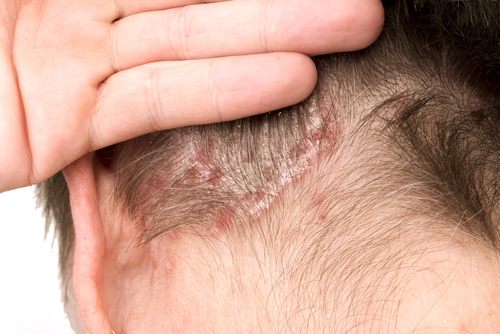 頭皮のフケと痒み マラセチア菌 が関わる 脂漏性皮膚炎 かも 公式 ウィルagaクリニック
