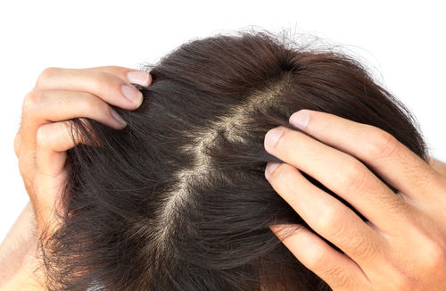 頭皮の血行不良が薄毛の原因 理由と症状 改善方法まで詳しく紹介 Aga 抜け毛 女性薄毛治療の病院 ウィルagaクリニック