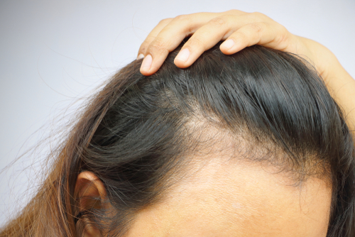 女性の薄毛問題 おでこハゲは早めの対策が鍵 Aga 抜け毛 女性薄毛治療の病院 ウィルagaクリニック