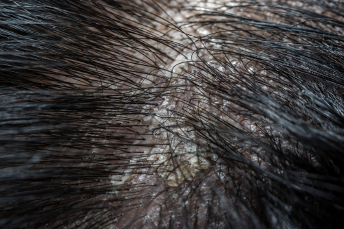 Aga治療には頭皮や毛穴の健康が大切 気になる正しいケア方法とは Aga 抜け毛 女性薄毛治療の病院 ウィルagaクリニック