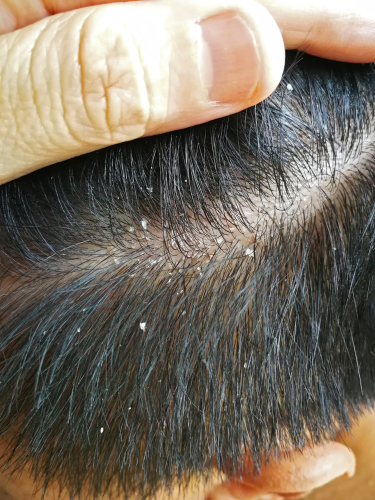 脂漏性皮膚炎とは 脂漏性皮膚炎と食事との関係 公式 ウィルagaクリニック