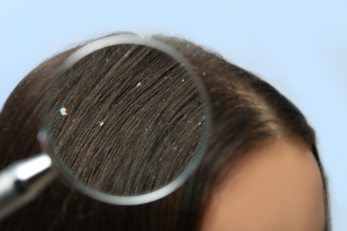 頭皮が脂っぽくなる原因は 困った症状と改善方法を詳しく紹介 Aga 抜け毛 女性薄毛治療の病院 ウィルagaクリニック