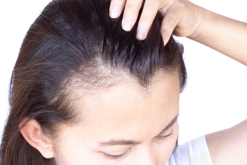 亜鉛に育毛は逆効果 薄毛予防には 効率よく亜鉛を摂る方法 公式 ウィルagaクリニック
