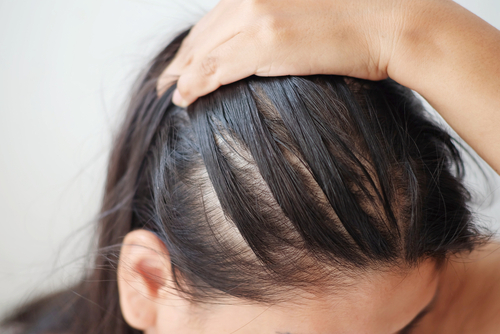 頭皮 髪 が薄い原因は 年代別の特徴 症状 対策方法を紹介 Aga 抜け毛 女性薄毛治療の病院 ウィルagaクリニック