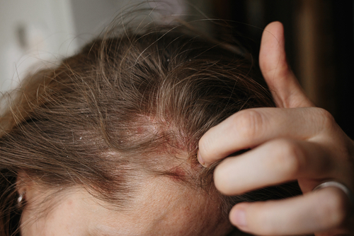 頭皮にもヘルペスはできる 湿疹 ブツブツ 炎症の原因と対処法 Aga 抜け毛 女性薄毛治療の病院 ウィルagaクリニック