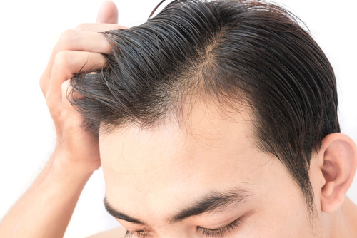 頭皮が脂っぽくなる原因は 困った症状と改善方法を詳しく紹介 Aga 抜け毛 女性薄毛治療の病院 ウィルagaクリニック