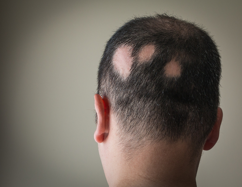 円形脱毛症の回復の兆しを解説 産毛が生えたら回復期の可能性あり Aga 抜け毛 女性薄毛治療の病院 ウィルagaクリニック