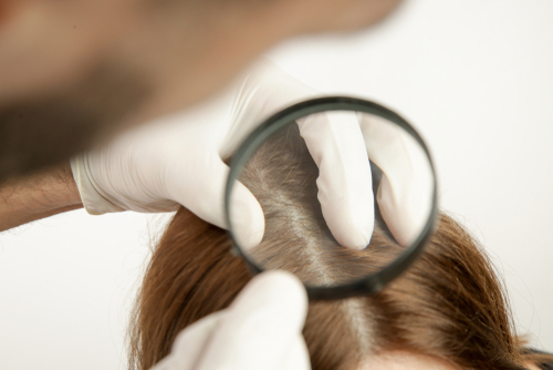 頭皮の毛包炎をどう治す 対処法と治療を解説 Aga 抜け毛 女性薄毛治療の病院 ウィルagaクリニック