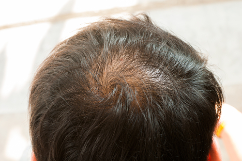 初期 脱毛 フィナステリド 初期脱毛は薬が効いている証拠！