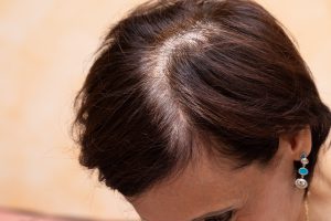 頭頂部への地毛植毛は難しい 治療法や費用は 公式 ウィルagaクリニック