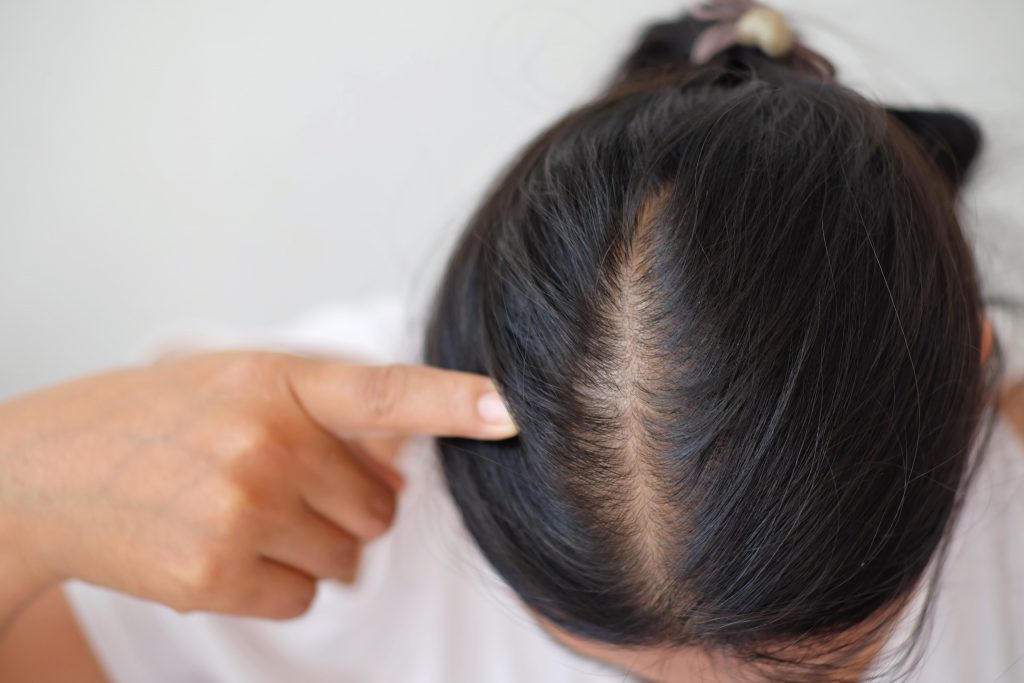 発毛成分ミノキシジルの作用機序を専門家が丁寧に解説 AGA・抜け毛・女性薄毛治療の病院 ウィルAGAクリニック