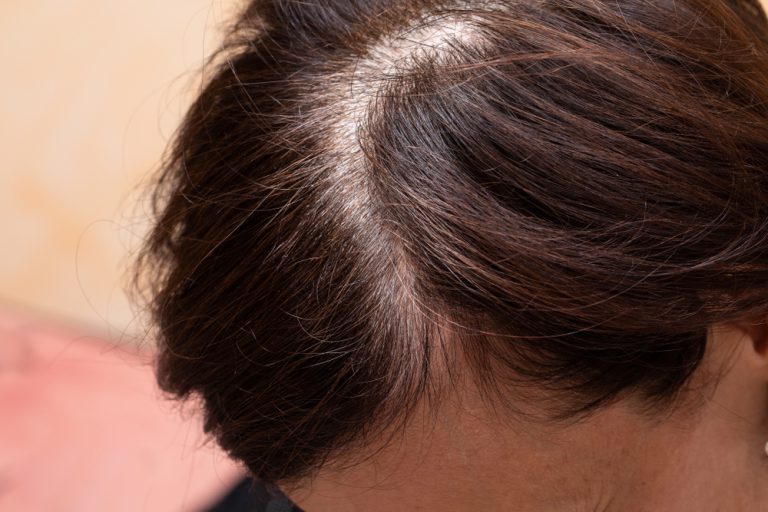つむじが線状に伸びている……ハゲとの見分け方や対策、予防法を紹介 AGA・抜け毛・女性薄毛治療の病院 ウィルAGAクリニック