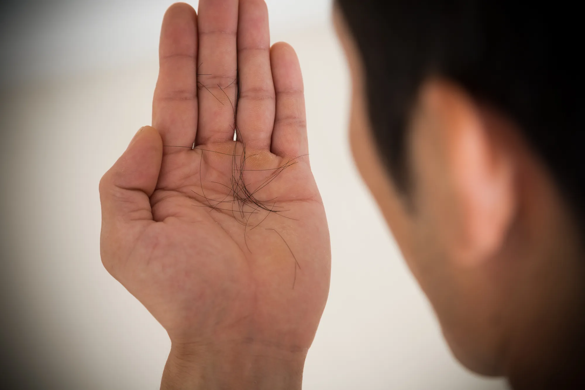 【男性】抜け毛を発症する主な原因とは？