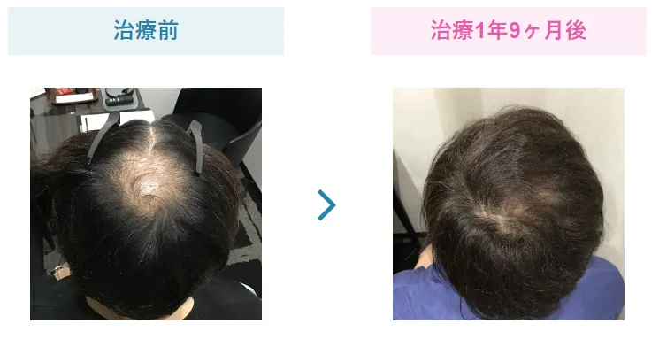 治療経過③【1年以上】発毛効果のピーク