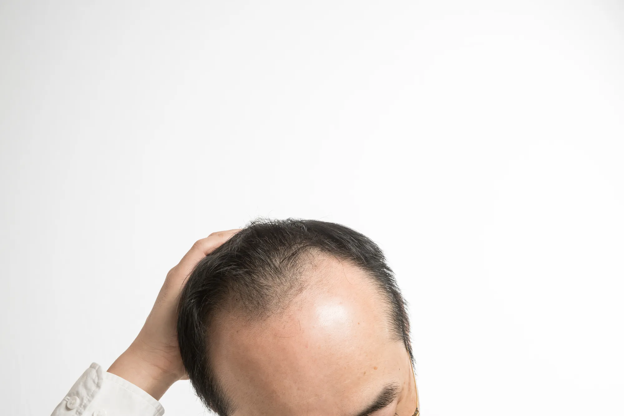 壮年性脱毛症になりやすい人の特徴