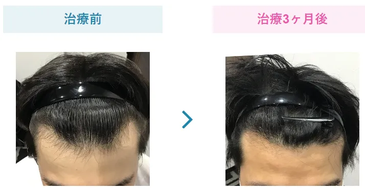 治療経過①【１～3ヵ月】抜け毛が軽減