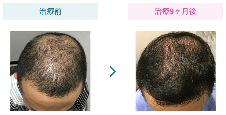 治療経過②【3ヵ月～1年】毛髪が徐々に増加