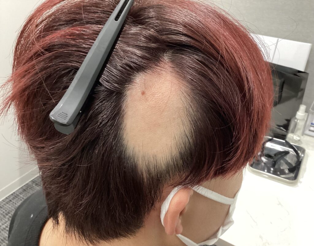 円形脱毛症例 22歳 Before