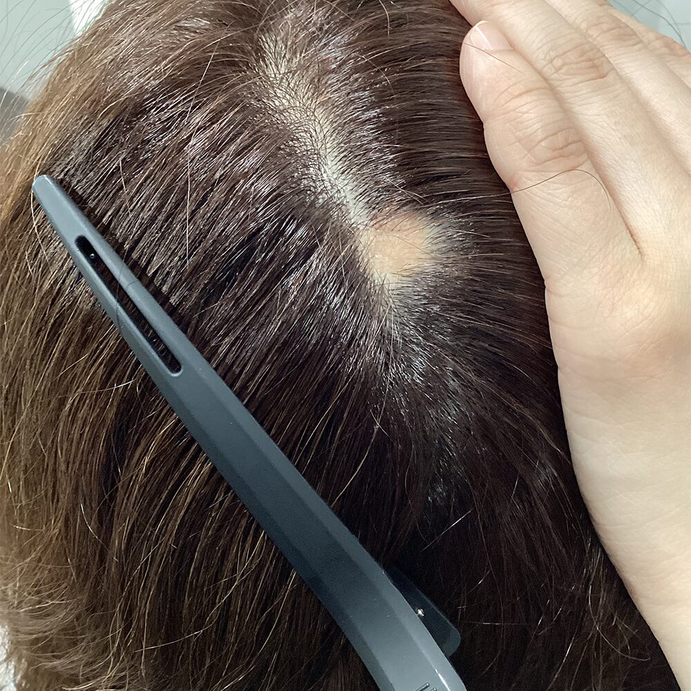円形脱毛症例 53歳 Before